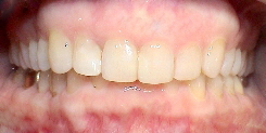 Behandlungsergebnis gerade Zähne
