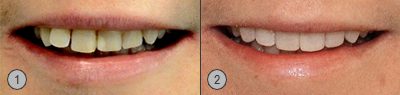 Vor und Nachher Bilder Bleaching Patientenbeispiel