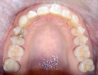 Invisalign nach Behandlung vom schiefen Zahn