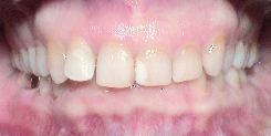 Invisalign® schiefe Zähne und Bleaching Therapie