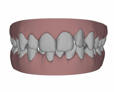 Clin Check Kiefergelenkknacken, Invisalign®