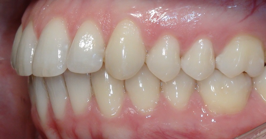 Deckbiss Invisalign® Therapie