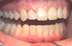 Behandlungsergebnis hypoplastischen Anteile