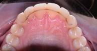 Invisalign Kiefergelenkknacken nach Behandlung