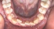 Invisalign® Kiefergelenkknacken Therapie