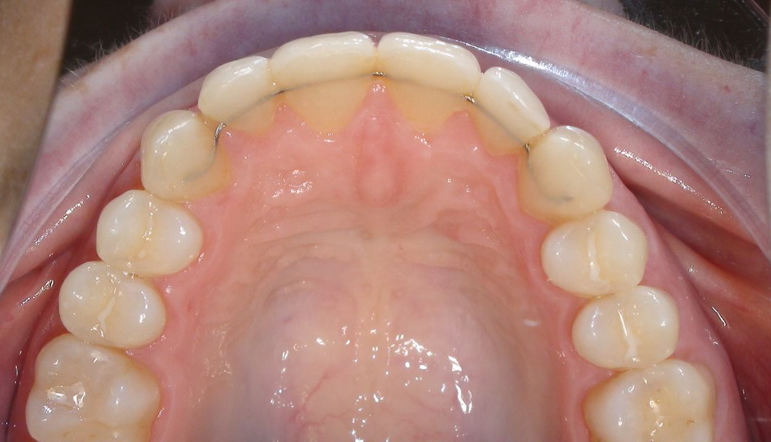 Invisalign Behandlung nach 11 Jahren