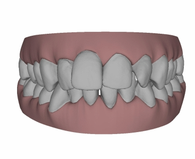 Patientin Beispiel Kieferschmerzen, Invisalign®