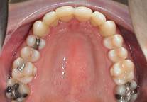 Invisalign nach Behandlung Kieferschmerzen