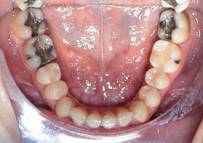 Nach Kieferschmerzen Invisalign® Therapie 