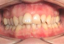 Invisalign® Zwangsrückbisses Therapie