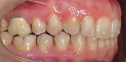 Behandlung Invisalign® nach Lingualtechnik