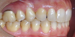 Patientenbeispiel nach Behandlung Invisalign®