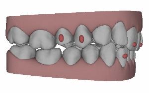 Clin Check Lingualtechnik, Invisalign®