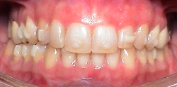 Invisalign® bevelled) Attachments