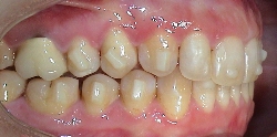 Invisalign® Case Refinement