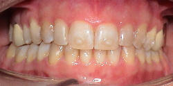 Invisalign® Lingualtechnik Therapie