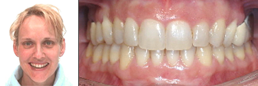 Nach Lingualtechnik Invisalign® Therapie