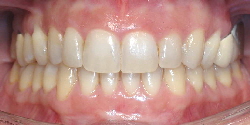 Nach Behandlung Invisalign®