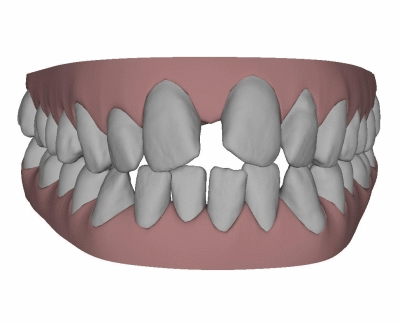 Patientin Beispiel Sigmatismus Lispel entfernen®