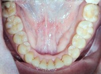 Nach Invisalign® Sigmatismus Therapie
