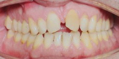Invisalign® Lispeln Therapie