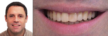 Nach Behandlung Zahnlücken