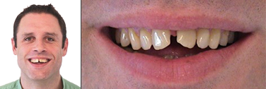 Vor Behandlung Zahnlücken