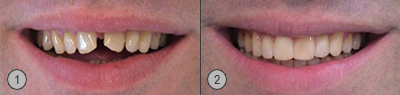 Vor und Nachher Bilder Lispeln bei Diastema mediale Patientenbeispiel