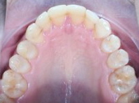 Invisalign Sigmatismus nach Behandlung