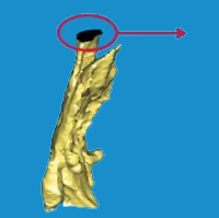 Offener Biss 3D CT Darstellung 