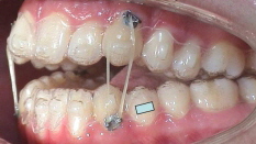 Invisalign Aligner mit Gummizüge 