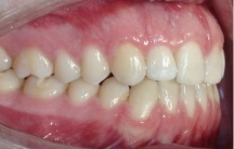Invisalign offener Biss nach Behandlung