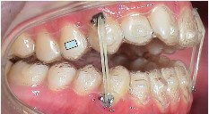 Intraorale Aufnahme mit  Gummizügen der Invisalign® Therapie