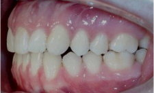 Nach Invisalign® Therapie offener Biss