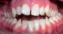 Invisalign® offener Biss Therapie