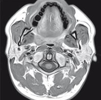 Offener Biss MRT Diagnose