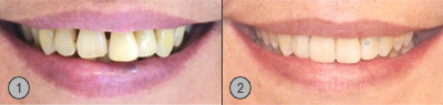Vor und Nachher Bilder Parodontose Patientenbeispiel