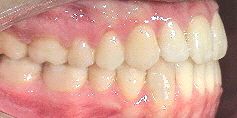 Invisalign Rezidiv nach Behandlung