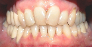 Vor Behandlung schiefer Zähne Bilder