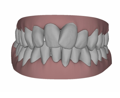 Patientin Beispiel Schiefe Zähne®