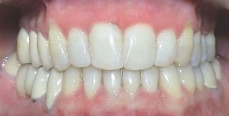 Nach Invisalign® Therapie schiefer Zähne