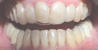 Invisalign® schiefer Zähne Therapie