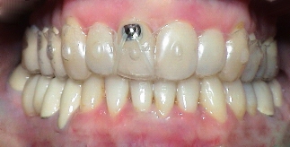 Behandlung der schiefen Zähne