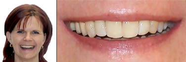 Nach Behandlung schiefe Zähne