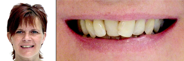 Vor Behandlung schiefe Zähne