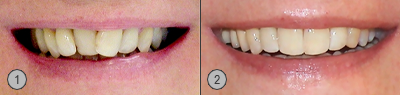 Vor und Nachher Bilder schiefe Zähne Patientenbeispiel