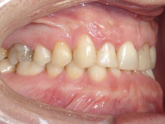 Invisalign offener Biss nach Behandlung