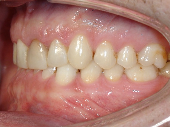 Nach Invisalign® Therapie des offenen Bisses