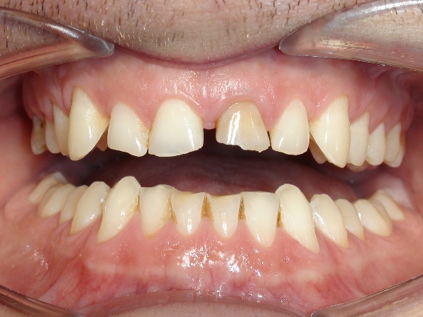 Invisalign® offener Biss Therapie