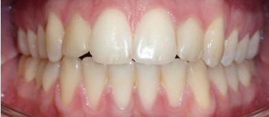 Behandlungsergebnis Twin Block